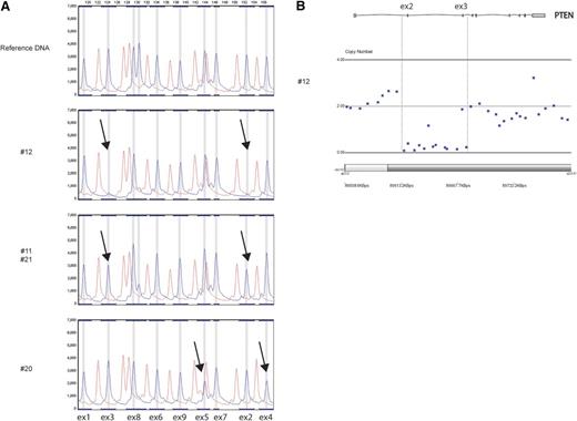 Figure 1. Identification of PTEN microdeletions in T-ALL patients. (A) MLPA electropherograms of normal reference DNA and representative examples of T-ALL patients with heterozygous or homozygous PTEN microdeletions affecting exons 2-3 or a heterozygous deletion of exons 4-5. Fluorescence intensities of amplified PCR products for specific PTEN exons are shown. PCR product sizes are shown at the top. Each arrow points to a homo- or heterozygously deleted exon. (B) Array-CGH plot exhibiting the homozygous PTEN exon 2-3 microdeletion in one T-ALL patient sample.