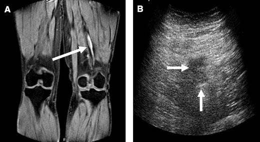 Figure 1. Abnormal signal on MRDTI in the popliteal vein of the left leg. (A) Arrow indicates positive MRDTI signal in a patient with symptomatic and CUS-proven ipsilateral recurrent DVT in the popliteal vein; (B) arrows indicate incompressibility of corresponding vein on ultrasonography.