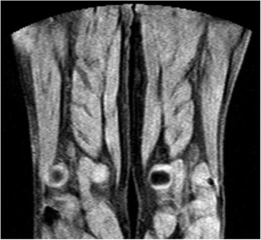 Figure 2. MDRTI image of a patient with ultrasonography-proven residual DVT but no acute recurrent thrombosis in the popliteal vein of the right leg. The scan did not indicate an abnormal MRDTI signal.