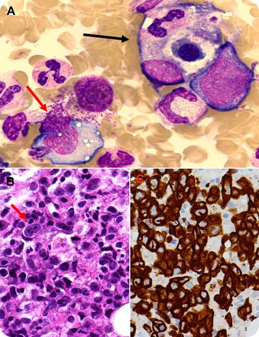 A 52-year-old HIV-positive man with a history of 2 weeks of intermittent fevers ≥38.7°C was admitted to the intensive care unit with treatment for a presumed infection. Cultures of his blood, urine, and sputum were negative for infection. Computed tomography of the thorax/abdomen/pelvis area detected hepatosplenomegaly and intrathoracic lymphadenopathy. Blood work revealed a possible hemophagocytic lymphohistiocytosis (HLH) with a hemoglobin value of 66 g/L, platelets 68 × 109/L, hypertriglyceridemia 7.67 mmol/L, and ferritin, 19 939 µg/L. Core inguinal lymph node biopsy results were nondiagnostic. Marrow aspirate showed significant hemophagocytosis, in which a histiocyte was engulfing an erythroid precursor and a neutrophil (panel A, black arrow). An adjacent large cell with irregular nuclear contour and basophilic cytoplasm with vacuoles were also observed (panel A, red arrow). Biopsy results highlighted the typical “hallmark” cell (panel B) and background hemophagocytosis. The abnormal cells were strongly positive for CD30 (panel C), CD3, CD4, CD25, EMA, and P53 but negative for ALK. T-cell receptor (TCR) gene rearrangement for the δ chain was clonal. A diagnosis of hemophagocytosis caused by marrow anaplastic large cell lymphoma (ALCL), ALK–, was made because the patient’s symptoms fulfilled 6 of the 8 diagnostic criteria. The patient died 2 weeks later. / HLH can be associated with many causes, such as infection, rheumatologic disorders, and immunodeficiency syndromes and malignancy—especially lymphomas—which include B, T/NK, and ALCL. Patients with lymphoma in whom HLH develops usually have an acute infectious/inflammatory trigger and are facing imminent death.