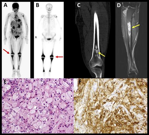 Characteristic histopathologic and radiographic findings of ECD. (A) PET and (B) 99mTc imaging demonstrating symmetric diametaphyseal radiotracer uptake in the long bones of the legs (arrows) commonly seen in ECD patients. (C) CT and (D) MRI scans revealing sclerotic lesions of the metaphyses of femur and tibia (arrows). (E) Hematoxylin-and-eosin–stained biopsy section of ECD lesion revealing lipid-laden histiocytes characteristic of ECD. (F) Immunohistochemical stain for CD68 revealing positivity of histiocytes. CT, computed tomography; PET, positron emission tomography. See Figure 1 in the article by Diamond et al that begins on page 483