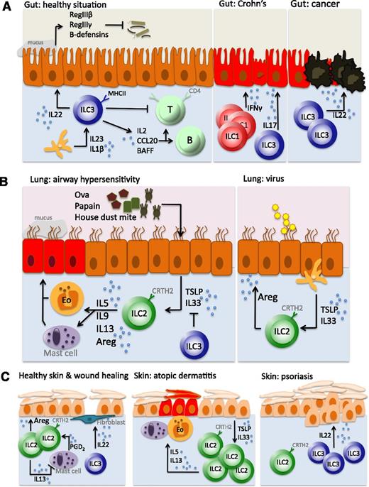 Figure 3. ILCs in gut, lung, and skin. (A) In the healthy situation, ILC3s produce IL-22 to maintain the epithelial barrier, generate antimicrobial products (such as RegIIIβ, RegIIIγ, and β-defensins), and suppress the reactivity of commensal bacteria-specific T cells (left panel). Crohn disease is characterized by an accumulation of IFN-γ–producing ILC1s (middle panel). During intestinal inflammation, ILC3s produce IL-22 to maintain epithelial barrier homeostasis. CRC develops when this autoregenerative function is not switched off in time (right panel). (B) Airway hypersensitivity is characterized by stromal production of TSLP and IL-33 that induces IL-5 and IL-13 production by ILC2s and subsequent recruitment and activation of eosinophils and mast cells (left panel). Upon viral airway infection, however, ILC2s are induced to produce amphiregulin, which is involved in airway epithelium repair and maintenance, and thereby function as tissue-protective cells (right panel). (C) In the healthy skin, ILC2s maintain close interactions with mast cells, suppressing their proinflammatory function, whereas ILC3s are involved in wound repair (left panel). Atopic dermatitis is an ILC2-mediated disease (middle panel), whereas ILC3s are accumulated in psoriasis (right panel).