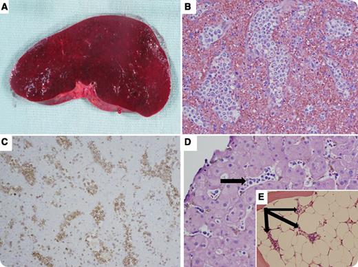 A 30-year-old man with an unremarkable medical history presented with fever, anemia, and thrombocytopenia, along with hepatosplenomegaly, for >1 month. Laboratory findings for infectious etiology were nondiagnostic. He underwent surgical resection for splenomegaly. The spleen weighed 983 g and measured 21 × 14.5 × 7 cm, with no identifiable gross lesions. The cut surface was homogeneous and red-purple (panel A). Histologically, there was marked dilation of the sinuses, which contained intermediate to large cells (panel B) that were positive for CD3 (panel C), CD2, CD7, CD8, CD56, and T-cell receptor δ (TCR-δ) and were negative for CD4, CD5, and TCR-αβ. The liver (panel D) and bone marrow (panel E) also showed the same sinusoidal involvement by lymphoma. / Hepatosplenic T-cell lymphoma is a rare, aggressive, extranodal lymphoma derived from cytotoxic T cells and is usually the γδ TCR type. The lymphoma exhibits a sinusoidal pattern of infiltration in the spleen, liver, and bone marrow. It occurs mainly in young adults presenting with splenomegaly and most often with hepatomegaly but without lymphadenopathy. The lymphoma cells are usually CD3+, CD2+, CD5−, CD7+/−, CD4−, CD8+/−, and CD56+/−. A number of cases have also been reported in patients with chronic immune suppression.