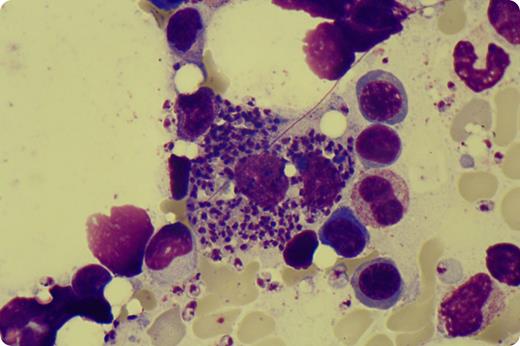 A 49-year-old man from rural Switzerland was diagnosed with chronic myeloid leukemia (CML) in 2007. He eventually underwent 9/10-HLA-matched unrelated stem cell transplantation (HSCT) because of intolerance to first- and second-line tyrosine kinase inhibitors. The early posttransplant period showed complete remission and was uneventful except for mild oral chronic graft-versus-host disease. Ten months after transplantation, when the patient was still under immunosuppressive therapy, we observed progressive pancytopenia. Further investigations included a bone marrow examination, which showed complete remission of CML; however, surprisingly, numerous leishmania amastigotes, both extra- and intracellular, were found within the macrophages. The diagnosis of visceral leishmaniasis by Leishmania infantum was confirmed by polymerase chain reaction, and prompt therapy with liposomal amphotericin B was initiated. The patient’s travel history was retrospectively unremarkable. / Visceral leishmaniasis is a well-known opportunistic infection in severe immunodeficiency, particularly in patients living in areas where leishmaniasis is endemic. It has rarely been seen after HSCT. The 3 potential sources of leishmania transmission in this case could have been the graft itself, transfusions of leishmania-infected blood, or reactivation of a preexisting leishmania infection induced by immunosuppression. Our case illustrates that leishmaniasis can be a cause of severe post-HSCT pancytopenia even in patients living outside areas of endemicity and without a specific travel history.