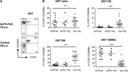 Figure 1. Distribution of differentiation subsets among ALPS and control DNT, according to CCR7 and CD45RA expression. (A) Representative plots showing CCR7 and CD45RA expression of ALPS vs control DNT. (B) Distribution of naïve (naïve, CCR7+CD45RA+), central memory (CM, CCR7+CD45RA−), effector memory (EM, CCR7−CD45RA−), and terminal differentiated T cells reexpressing CD45RA (TEMRA, CCR7−CD45RA+) among DNT (gate: CD3+TCRαβ+CD4−CD8−) of all studied ALPS patients (ALPS all), adult ALPS patients (ALPS >18 y), and adult controls (Con >18 y). Because pediatric and adult patients had a similar distribution, statistical comparison was performed between all ALPS patients and adult controls. ns, not significant. *P < .05; **P < .01; ***P < .001.