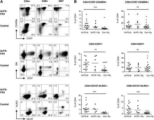 Figure 3. T cells resembling DNT can be detected among CD4+ and CD8+ T cells of ALPS patients. (A) Representative plots showing the proportions of CCR7-CD45RA+TEMRA, CD57+ and CD127−KLRG1− T cells among ALPS versus control CD4+ T cells and CD8+ T cells. (B) Percentages of these populations in all studied ALPS patients (ALPS all), adult ALPS patients (ALPS >18 y) and controls (Con >18 y) with statistical comparison between all ALPS patients and adult controls. ns, not significant. **P < .01; ***P < .001.