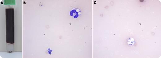 A 61-year-old female patient with an uneventful medical history was admitted to the emergency department because of icterus and abdominal discomfort. Upon arrival, she was hemodynamically stable. No laboratory tests could be performed because of a massive hemolysis (panel A), so the decision was made to perform a direct blood smear, which showed 2 species of bacteria and erythrophagocytosis (panels B and C). The patient deteriorated acutely and was admitted to the intensive care unit, where she was intubated and started on massive inotropes and broad-spectrum antibiotics, under the hypothesis that she was in septic shock. Repeated blood samples showed severe hemolysis with no possibility of chemical or hematologic testing. The patient died within 1 hour as a result of overwhelming sepsis. Postmortem blood cultures showed Clostridium perfringens and Escherichia coli bacteremia. The autopsy revealed an infected hematoma in the liver hilum as the source of the sepsis. / Clostridium septicemia is known for its massive hemolysis and poor prognosis. This case shows that a direct blood smear can be a fast and relevant test to diagnose severely ill patients.