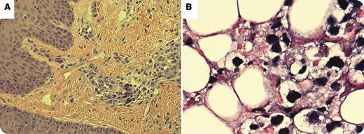 A 25-year-old male with AIDS (CD4 count, 59/mm3) presented with fever and fatigue. He was thrombocytopenic (platelet count, 9 × 109/L) and had a lactic acid level of 9.0. mmol/L. Examination was notable for hepatosplenomegaly without lymphadenopathy. Lactic acid peaked at >31 mmol/L associated with an elevated lactate dehydrogenase of 27 920 IU/L on the fourth hospital day. Bone marrow biopsy revealed large lymphoma cells positive for CD20. Soon after admission, he developed a papular erythematous rash limited to the face. Skin biopsy of his right cheek revealed sheets of lymphoid cells infiltrating the dermis (panel A, hematoxylin and eosin) with cells expressing CD79, PAX5, and CD20 (not shown) with positive Epstein-Barr virus (EBV) nuclear staining (panel B, in situ hybridization), consistent with EBV-driven HIV-associated diffuse large B-cell lymphoma. / Profound lactic acidosis is a rare complication of lymphoma. In the small number of reported cases, lactic acidosis resolved only after initiation of chemotherapy to induce cytoreduction of the underlying malignancy. A majority of patients, like this one, quickly succumb to the disease. The pathogenesis of lactic acidosis in hematologic malignancies remains unclear, although it portends a poor prognosis when present.