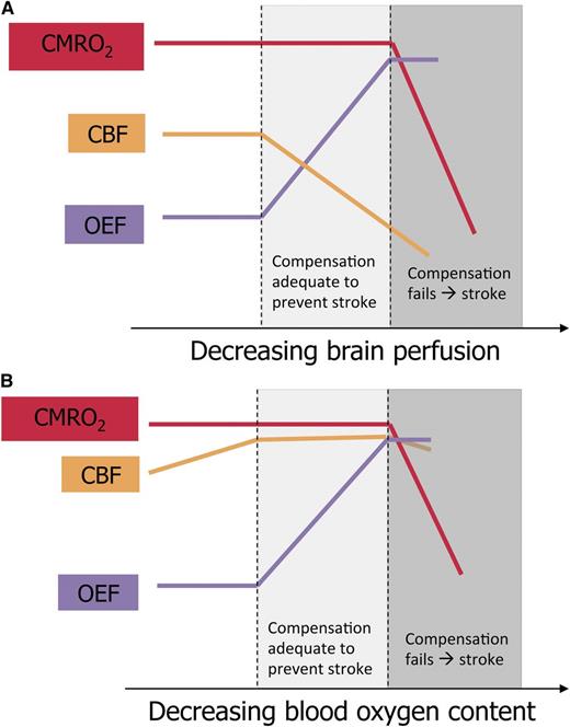 Schematic representation of brain perfusion, oxygen extraction, and oxygen metabolism in children with SCA. (A) Proposed model of cerebral infarction in SCA with cerebral vasculopathy. CBF declines as vasculopathy progresses. The percentage of oxygen extracted from the blood by the brain (OEF) increases to maintain adequate tissue oxygen utilization (CMRO2). When CBF continues to fall and OEF cannot increase further, CMRO2 drops, causing cerebral infarction. (B) Proposed model of cerebral infarction in SCA without cerebral vasculopathy. CBF is elevated to compensate for decreased blood oxygen content and has limited additional capacity to increase. As blood oxygen content falls due to acute illness, OEF increases to maintain adequate CMRO2. When OEF is maximized, a drop in CBF may cause CMRO2 to fall, and infarction ensues. The figure has been adapted from Powers4 with permission.