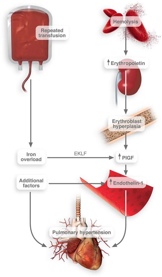 Connection between transfusion frequency and pulmonary hypertension in SCD. Iron overload induces the activation of EKLF transcription factor in erythroblasts. These cells then release PlGF, which promotes the release of endothelin-1. Thus, when combined with other pathological factors in SCD, pulmonary hypertension may result. Professional Illustration by Luk Cox.