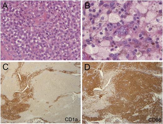 Figure 1. Histology of a patient with mixed histiocytosis. LCH and ECD lesions were present but distinguishable in the same biopsy from a patient with mixed histiocytosis. This sample (patient 8) contained (A) typical LCH as well as (B) ECD infiltration (HandE stain, original magnification ×200). On serial sections, immunohistochemistry showed (C) strong CD1a staining contrasting with (D) strong CD68 staining in distinct areas (original magnification ×40).