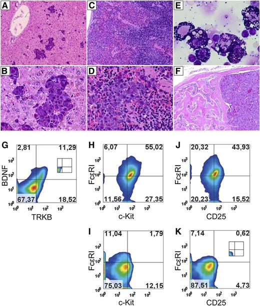 Figure 1. Development of SM in mice transplanted with TRKB- and BDNF-modified hematopoietic stem/progenitor cells. (A-F) Representative histopathology (hematoxylin and eosin) and cytology (May-Grünwald-Giemsa) from 2 animals (A-E: mouse 1007, F: mouse 746). The World Health Organization criteria for human SM were fulfilled in diseased animals.6,7 Multifocal, dense infiltrates of mast cells (≥15 mast cells in aggregates) were observed in different organs. (A-B) Sections of liver showing infiltration of mast cells in liver (×100, ×400). (C-D) Accumulation of mast cells in the red pulp of spleen (×100, ×400). (E) Cytospin of spleen showing mature, round (typical) mast cells with abundant cytoplasm filled with granules (×1000). Note phagocytosis of red cells in some mast cells (B,E). Spindle-shaped slightly hypogranular mast cells were also observed in other animals (data not shown). (F) Low-magnification views of bone marrow section showing extensive infiltration of mast cells in sternum and osteosclerosis (×100). However, cytospin of bone marrow cells from tibia showed <20% of mast cells. Moreover, kidney infiltration of mast cells was observed in some animals with SM (data not shown). It is important to note that spleen and liver were affected in all animals with SM, whereas some animals did not have infiltration of mast cells in bone marrow. Unfortunately, skin and gut were not collected for histological analyses, because we do not routinely analyze these for leukemogenesis studies. (G-K) Representative flow cytometric diagrams from animal 714. Flow cytometric analysis showing expression of transgenes (BDNF and TRKB, measured by enhanced green fluorescent protein (EGFP) and antibody against hemagglutinin-tag, respectively) in spleen (G, negative control shown as inset), expression of c-Kit and FcεRI in transgene positive (H) and transgene negative population (neither TRKB nor BDNF) (I), and expression of FcεRI and CD25 (marker for neoplastic mast cells) in transgene positive (J) and transgene negative populations (K, negative control for panels H-K shown as inset). These demonstrated that abnormal mast cells were derived from gene-modified cells. It is interesting to note that in SM mice, both autocrine and paracrine loops may have contributed to mastocytosis (Figure 1G), whereas we observed a clear selection for both lymphoid leukemia (supplemental Figure 4) and myeloid leukemia transformation by autocrine activation of TRKB.4 Activation of TRKB in hematopoietic stem/progenitor cells induced 2 different phenotypes in vivo, ie, SM and lymphoblastic leukemia. This might be due to different cell populations targeted,10 although other factors might also be involved.