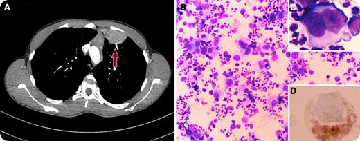 A 15-year-old young man presented to the emergency department with a 3-week history of sharp left-sided chest pain, shortness of breath on exertion, and a low-grade intermittent fever. Chest radiograph revealed increased density in the upper left lobe, thus he was treated with antibiotics for query pneumonia. Although his fever subsided, the patient continued to have chest pain, and subsequently developed night sweats and fatigue. Chest computed tomography revealed complex soft tissue, mostly located in his left lung, and minimally enlarged mediastinal lymph nodes (panel A). The differential diagnosis included sarcoma, congenital cyst, and lymphoma. The suspicious lung mass was resected for pathology. The cytospin results showed numerous large atypical cells in a background of neutrophils, eosinophils, lymphocytes, and histiocytes (panel B). The atypical cells often had abundant cytoplasm, and the nuclei often contained prominent nucleoli. Typical Reed-Sternberg cells are noted with a bi-lobed nucleus, giving the cell a typical “owl’s eyes” appearance (panel C). Cells showed CD30 positivity with immunohistochemistry stains (panel D). / A diagnosis of nodular sclerosis Hodgkin lymphoma stage IIB was made. The patient was started on adriamycin-bleomycin-vinblastine-dacarbazine combination chemotherapy, with favorable response. Primary pulmonary Hodgkin lymphoma is a very rare entity whose prognosis depends on its stage.