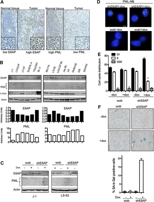 Figure 7. E6AP levels are elevated in human Burkitt lymphomas and downregulation of E6AP restores PML-induced cellular senescence. (A) Representative images of E6AP (left panel) and PML (right panel) immunostaining in human Burkitt lymphomas. Expression of E6AP is relatively low in normal lymphoid tissue, but the infiltrating Burkitt lymphoma cells show elevated levels of E6AP accompanied by reduced levels of PML; N = 20; Magnification ×200. (B) Immunoblot analysis to determine the levels of E6AP, PML, and c-Myc in a panel of cell lines derived from Burkitt lymphoma derived (J-1, LOUCIF, LY-67, BL-2, MC116, LS-92, LOUCIF-BL, JOY-BL), DLBCL (SUDHL-4, FARAGE, TOLEDO, DB, HT), or follicular lymphoma (DOHH2). Probing for actin was used as a loading control. The expression levels of E6AP and PML normalized against the levels of actin were quantified and are presented on the graphs (bottom panel). (C) Immunoblot analysis of the indicated proteins in J-1 and LS-92 Burkitt lymphoma derived cells transduced with inducible lentiviral constructs containing wobble E6AP or shRNA for E6AP that were treated with (+) or without (−) doxycyclin. Cells were analyzed 7 days after doxycyclin (dox) induction. Probing for actin was used as a loading control. (D) Immunofluorescence staining of PML-NBs in J-1 Burkitt lymphoma cells transduced with the aforementioned shRNA expression constructs on day 7 after dox treatment. Magnification ×1000. (E) Cell-cycle analyses of J-1 Burkitt lymphoma cells transduced with the aforementioned shRNA expression constructs performed on day 7 after dox induction; *P < .001. Values represent means ± SD. (F) SA-β-gal levels were determined in cytospins of J-1 Burkitt lymphoma cells transduced with the aforementioned shRNA expression constructs on day 7 after dox treatment. Magnification ×400. Quantification of SA-β-gal positive cells: > 400 cells/cytospin, n = 3, cells were counted in 4 randomly selected fields. Values represent means ± SD, and were derived from 3 independent experiments performed in triplicate.