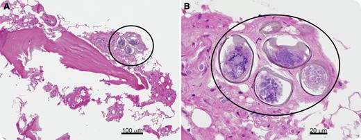 A 72-year-old man with a history of high-grade urothelial carcinoma presented for evaluation of suspected multiple myeloma. He had a remote history of schistosomal infection 20 years earlier while in Vietnam. Significant labs at presentation demonstrated a hemoglobin of 12.2 g/dL, calcium of 11.8 mg/dL, and acute renal failure with a creatinine of 3.9 mg/dL. A computed tomography scan demonstrated a lytic lesion at T9. Serum protein electropheresis found no monoclonal protein. / Subsequent bone marrow biopsy was fragmented and hypocellular at <5% for age with no evidence of a plasma cell dyscrasia, with only 1% plasma cells and an incidental finding of Schistosoma eggs. Two magnifications show eggs in the context of the bone marrow (panel A, circle) and isolated (panel B, circle). After further evaluation, the cause of the patient’s condition could not be confirmed, and he died shortly thereafter. Additional testing of the specimen was not possible because tissue processing destroyed egg DNA. Based on the patient’s history and morphology of the embryonated eggs (nearly spherical) and size (48-51 μm), they are presumed to be Schistosoma mekongi. Other organ system involvement by Schistosoma has been reported, including gastrointestinal, pulmonary, central nervous system, skin, and genitourinary involvement, but, to our knowledge, this is the first reported case identified on bone marrow biopsy.