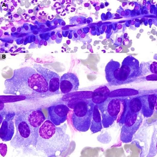 A 32-year-old man with a history of severe mental retardation presented with a bulky 11.7 cm × 6.8 cm superior mediastinal mass, confluent 5.3 cm × 3.9 cm right hilar lymphadenopathy, and a cavitary right upper lobe lung mass. HIV serology was negative. A core biopsy of the mediastinal mass showed a mixed inflammatory infiltrate with scattered large mono- and binucleated Hodgkin-Reed-Sternberg cells with prominent macronucleoli expressing CD15, CD30, and PAX5, without CD3, CD20, or CD45 by immunohistochemistry. The staging marrow was negative for lymphoma; however, a visually impressive sheath of small, mature plasma cells was observed in the pericapillary space on the aspirate smear (panel A), reminiscent of a “plasma cell ribbon” (panel B). A diagnosis of unfavorable-risk classical Hodgkin lymphoma (stage IIAX) was made. Due to concerns about poor patient compliance and agitation, a decision was made to treat him with local radiation only. / Pericapillary localization of polytypic plasma cells in the marrow is a physiologic phenomenon rarely observed on aspirate smear preparations. The intimate association between plasma cells and endothelial cells early in the development of blood vessels facilitates transport of immunoglobulins from plasma cells into the circulation. As the muscularis layer forms, pericapillary plasma cells disappear.