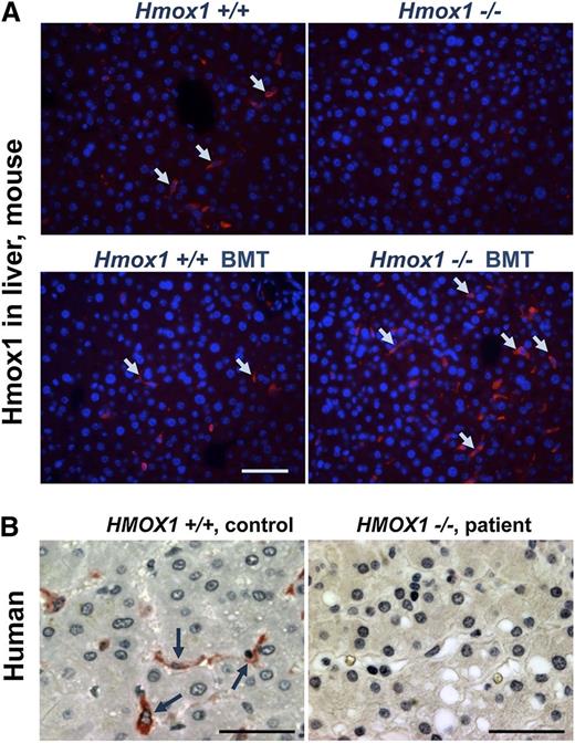 Figure 5. Comparison of Hmox1 protein expression in mouse and human liver tissue of controls with Hmox1-deficient animals and patient samples. (A) Cross-sections of paraffin-embedded liver tissue immunofluorescence showed that Kupffer cells were a major site of Hmox1 expression in both WT Ctr and WT BMT mice (left); no specific Hmox1 signal was detectable in the liver KO Ctr animals (upper right); an Hmox1-expressing Kupffer cell population was restored in the liver of transplant recipients (bottom right). Arrows point to Hmox1-positive cells. (B) A human liver biopsy specimen obtained from human with intact HMOX1 gene showed high HMOX1 signal present in Kupffer-like cells (left), whereas there was no HMOX1 expression in the liver sample of an HMOX1-deficient patient specimen (right). Scale bars represent 50 μm (A) and 25 μm (B).
