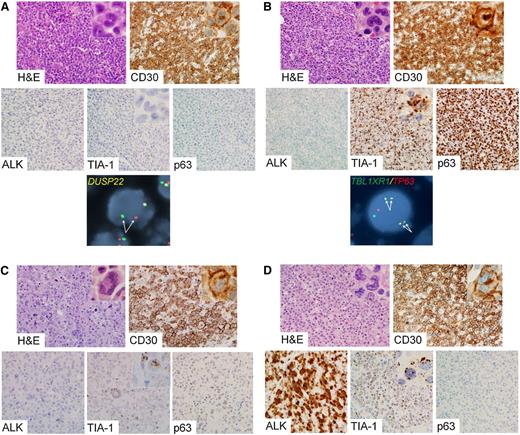 Figure 2. Representative cases of genetic subtypes of ALCL. (A) ALK-negative ALCL with DUSP22 rearrangement. The tumor cells are positive for CD30 and are negative for ALK, TIA-1, and p63. FISH using a breakapart probe to the DUSP22-IRF4 locus on 6p25.3 shows abnormal separation of the red and green signals on 1 allele (pair of arrows). (B) ALK-negative ALCL with TP63 rearrangement. The tumor cells are positive for CD30, TIA-1, and p63 and are negative for ALK. FISH using a dual-fusion probe to TBL1XR1 on 3q26 and TP63 on 3q28 demonstrates 2 pairs of abnormal fusion signals, indicating 2 copies of inv(3)(q26q28) (TBL1XR1/TP63 fusion; 2 pairs of arrows). (C) ALK-negative ALCL lacking DUSP22 and TP63 rearrangements (triple-negative ALCL). The tumor cells are positive for CD30 and TIA-1 and are negative for ALK and p63. (D) ALK-positive ALCL. The tumor cells are positive for CD30, ALK, and TIA-1 and are negative for p63. Photomicrographs were taken using an Olympus DP71 camera, Olympus BX51 microscope, and Olympus DP Manager image acquisition software at an original magnification of ×400 (insets, ×1000). Original magnification of FISH images, ×600.