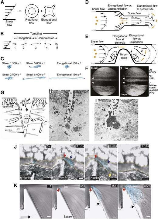Figure 4. Shear and elongational flows and relation to platelet plug formation and thrombosis. (A) Shear flow, which may be represented as elongational flow superimposed on rotational flow.40,41 Arrows show streamlines and dots regions of no flow. (B) Cartoon of VWF elongating, compressing, and tumbling in shear flow.43 (C) Stills representing the last frame of movies simulating VWF in shear and elongational flows at the indicated rates (supplemental Videos 1-6). VWF is represented as a string of 50 spheres (cyan except for spheres at the 2 ends in magenta). Simulations are similar to those described in Schneider et al35 and Sing and Alexander-Katz.44 Simulations and movies are courtesy of Darren Yang and Wesley Wong (Children’s Hospital, Boston, MA). Both shear and elongational flows are measured as velocity/distance and have units of s−1. VWF becomes thread-like at much lower values of elongational flow than shear flow. (D-E) Shear and elongational flows in a bleeding vessel (D) and stenotic vessel (E). Round orange spheres show the effect of elongational flow on the shape of a polymeric protein in the flow field.44 Two zones of elongational flow marked 1 and 2 are described in “The shape of VWF” section. Elongation of VWF concatemers would occur in the directions shown by the orange globules. (F) Light micrographs of rat mesentery artery (top) and vein (bottom) before and 9 minutes after the wall of the vein was nicked with scissors. Reprinted from Zucker96 with permission. A platelet plug (arrow) lies above the vein. Vasoconstriction occurs in both the artery and vein and is only seen when a platelet plug is formed, demonstrating that platelet plugs release a diffusible vasoconstrictor.96 (G-I) Human skin wound experiment for determination of bleeding time. Reprinted from Wester et al95 with permission. (G) Schematic showing the morphology of the hemostatic plug (HP) formed by a transected vessel (Vs). The plug is 90% outside the vessel. (H-I) Biopsy excised 30 seconds after wounding. Two light micrographs a few sections apart are shown of the same hemostatic plug (HP) formed at the outflow of a transected vessel. D, dermis; E, epidermis; Vs, transected vessel; W, wound. (J-K) Differential interference contrast microscopy of thrombosis formation at sites of vessel constriction in vivo (J) and in vitro (K), reprinted from Nesbitt et al100 with permission. Flow is left to right. Scale bars are 10 μm. (J) Mouse mesenteric arteriole crush injured with a needle. A platelet aggregate (cyan shading) forms downstream of the injury and stenosis site (red arrow). Blue and yellow arrows mark the center and downstream extent of the platelet aggregate. Time is shown in seconds. After release of the stenosis the aggregate embolized (24 seconds). (K) Whole blood in a microchannel with a 90% stenosis and downstream expansion. Red and black arrows mark the margins of the platelet aggregate (cyan shading). Much less aggregation was noticed with a lower rate of downstream expansion; that is, with lower elongational flow rates.100