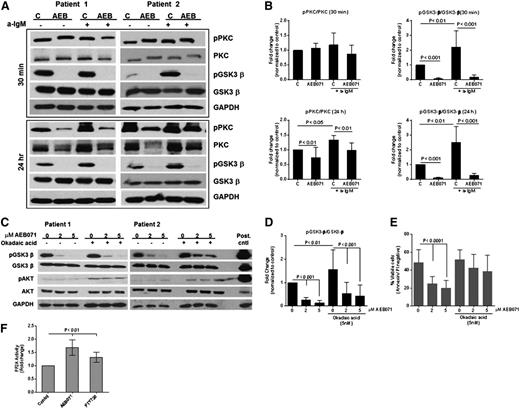 Figure 5. GSK3-β contributes to AEB071-induced effects in B-CLL. (A-B) CD19+ cells from CLL patients (N = 9) were treated with AEB071 (2 μM) and stimulated with immobilized anti-IgM for 30 minutes or 24 hours. PKC phosphorylation at Thr638/641 and GSK3-β phosphorylation at Ser9 was assessed by immunoblot. Results from 2 patients are shown and band quantification is represented as fold change from unstimulated control (mean ± SD). (C-D) CD19+ cells from CLL patients (N = 6) were pretreated with media or okadaic acid (5 nM) for 2 hours, followed by incubation for 3 hours with AEB071 (2 or 5 μM). GSK3-β phosphorylation at Ser9 and AKT phosphorylation at Ser473 was assessed by immunoblot. Results from 2 patients are shown and GSK3-β band quantification is represented as fold change from unstimulated control (mean ± SD). (E) CD19+ cells from CLL patients (N = 4) were pretreated with media or okadaic acid (5 nM) for 2 hours, followed by incubation with AEB071 for 48 hours. Cell viability was measured by annexin/PI staining and expressed as mean ± SD. (F) CD19+ cells from CLL patients (N = 3) were treated with AEB071 (2 μM) or FTY720 for 5 hours. Enzymatic activity of PP2A in the cell lysates was measured by a nonradioactive assay as described in methods and expressed as fold change from untreated control (mean ± SD).