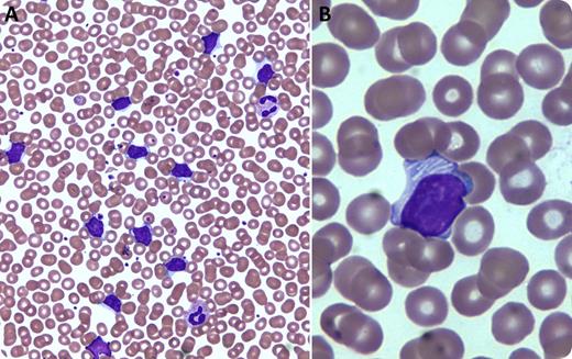 An 84-year-old man with Rai stage 1 chronic lymphocytic leukemia (CLL) and an immunoglobulin (Ig)M λ paraprotein in serum (0.16 g/dL) presented for routine follow-up. The monoclonal B-cell immunophenotype was previously reported as λ light chain-restricted CD19+CD20 (low density)+CD5+CD10−CD23+CD22−CD21+CD43+FMC7−CD11c− surface IgM+; prognostic factors included CD38− and only 13q− by in situ hybridization, both associated with a favorable prognosis. Total white cell count was 48 700/μL (89% lymphocytes) with no anemia or thrombocytopenia. Wright-Giemsa-stained peripheral blood smear examination revealed numerous moderate-sized abnormal lymphocytes with irregular nuclei and moderate cytoplasm, but only rare visible nucleoli, atypical for CLL (panel A; ×50 magnification). About 20% of the abnormal lymphocytes possessed pale-to-white, tubular “filamentous-like” cytoplasmic inclusions (panel B; ×100 magnification). / Cytoplasmic inclusions in the abnormal lymphocytes of CLL are rare, although some observations of similar filamentous-like structures have been reported. Previous studies have indicated that these inclusions represent rough endoplasmic reticula that have become visible as a result of dilation and filling with immunoglobulin deposits. Although only a handful of cases have been reported and atypical morphology such as seen in this patient correlates with less favorable prognosis, the inclusions per se do not appear to have clinical significance.