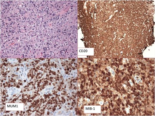 Figure 1. Primary mediastinal B-cell lymphoma. Hematoxylin and eosin is shown and CD20 and MUM1 staining are positive. MIB-1 scoring is high. (Figure courtesy of Stefania Pittaluga.)