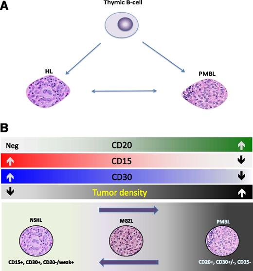 Figure 2. Spectrum of mediastinal B-cell lymphomas. (A) Both PMBL and Hodgkin lymphoma (HL) are putatively derived from a thymic B cell. The events that transform a thymic B cell into PMBL or HL are poorly understood, but there appears to be plasticity in these events, as HL can recur as PMBL and vice versa. (B) Although NSHL is CD15- and CD30-positive and PMBL is CD20-positive, there are mediastinal lymphomas between these 2 entities with histologic and immunohistochemical features intermediate and transitional between NSHL and PMBL. These diseases are MGZLs.