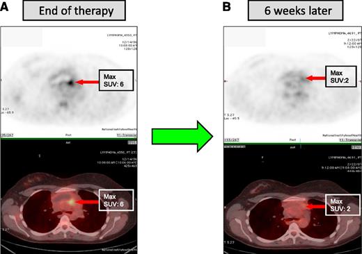Figure 4. FDG-PET imaging after completion of therapy in PMBL. These are sequential FDG-PET scans of a patient with PMBL who received 6 cycles of DA-EPOCH-R. (A) Three weeks after the completion of therapy, there was an FDG-PET avid lesion in the anterior mediastinum with an standardized value of 6. (B) The patient was followed, and approximately 6 weeks later had another FDG-PET (B). The lesion now had a standardized value of 2. A subsequent FDG-PET scan 6 weeks later was entirely normal, and the patient remains in complete remission several years later.