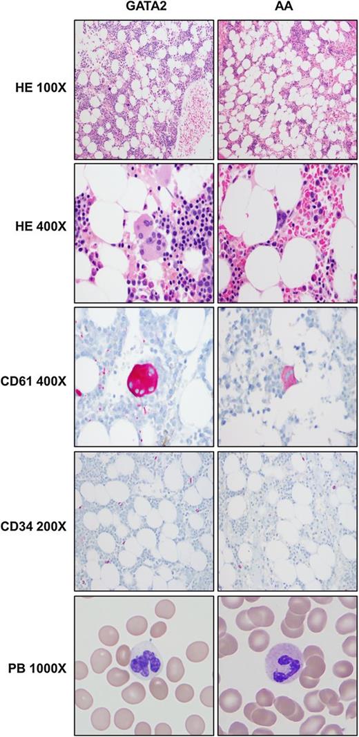 Figure 5. Comparison of peripheral blood and bone marrow morphologic and immunohistochemical features between GATA2 and AA patients. GATA2 patient marrows have greater overall cellularity, increased megakaryocytes with atypical features (highlighted by CD61), but overall similar numbers of CD34-positive cells compared with AA marrows. A subset of GATA2 patients has hypogranular circulating neutrophils.