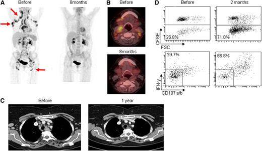 Figure 3. Complete clinical response and T-cell responses in patient number 2. (A-B) PET/CT scans taken before start of treatment and at 8 months. (C) CT from before treatment and at 1 year. (D) Flow cytometric measurements of antitumor CD8+ T-cell responses in peripheral blood drawn before treatment and at 2 months postvaccination, following 5 days of coculture with autologous T cells. Upper dot plots: Percent proliferating cells, measured as CD3+CD8+CD20– events showing low CFSE fluorescence. Lower dot plots: On day 5, cocultures of MNCs and tumor cells were restimulated with autologous tumor cells for 5 hours before measuring degranulation (CD107 a/b expression) and secretion of IFN-γ. Numbers represent percent responding cells.