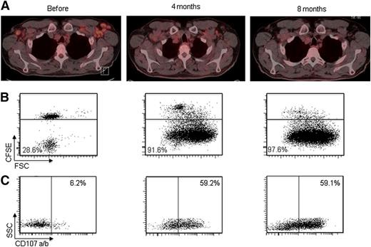 Figure 4. Complete clinical response and vigorous T-cell responses in patient number 5. (A) PET/CT scans before treatment and at 4 and 8 months. Proliferation (B) and degranulation (C) of CD8+ T cells is shown in samples taken before treatment and at 4 and 8 months, analyzed as described in the legend of Figure 1.