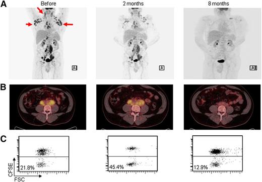 Figure 5. Partial clinical response and T-cell response in patient number 8. (A-B) PET/CT scans before treatment and at 4 and 8 months. (C) CD8 T-cell proliferation monitored before treatment and at 2 and 8 months, as described in the legend of Figure 1.