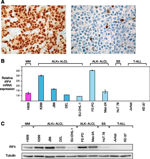 Figure 1. IRF4 is highly expressed in ALCL. (A) Immunohistochemical IRF4 staining of an IRF4-positive ALCL case (left) with internal negative controls (tumor-infiltrating macrophages and endothelia), and an IRF4-negative ALCL case (right) (original magnification ×320). (B) IRF4 mRNA is highly expressed in ALCL compared with the SS cell line HuT 78 and T-ALL cell lines as measured by quantitative PCR. IRF4 mRNA levels were normalized to expression of GAPDH. Error bars indicate standard deviation. (C) Western blot analysis of IRF4 expression in MM, ALCL, SS, and T-ALL cell lines. Five of 6 ALCL cell lines have high IRF4 protein expression.