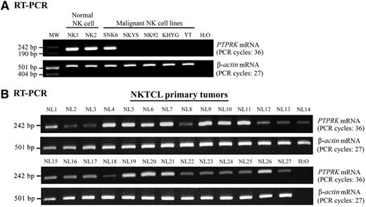 Figure 1. PTPRK mRNA is frequently underexpressed in NKTCLs. Gel images show the PTPRK mRNA expression levels as detected by semiquantitative RT-PCR in 2 samples of normal NK cells, 5 NKTCL cell lines (A), and 27 NKTCL primary tumors (B). The mRNA expression in each sample was normalized to β-actin expression. PTPRK mRNA was highly expressed in normal NK cells, but frequently not detected in NKTCL cell lines and significantly underexpressed in more than half of the NKTCL primary tumors.