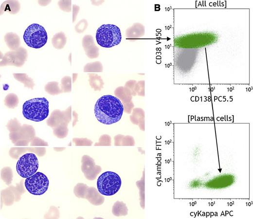 A 59-year-old man suspected of acute transplant rejection after a recent heart allograft (<1 month) was treated with intensive immunosuppressive therapy. The clinical examination found renal failure without lymphadenopathy, organomegaly, or osteolytic lesions. / The complete blood count, initially normal before allograft, showed anemia, thrombopenia, and a leukocytosis (22 × 109/L) with rouleau formation and 67% circulating plasma cells with a round eccentric nucleus, clumped chromatin, and abundant basophilic cytoplasm on the blood film (panel A). Serum and immunofixation electrophoresis revealed 23.1 g/L of serum immunoglobulin A (IgA) monoclonal protein. Laboratory data revealed elevated serum lactate dehydrogenase and β-2 microglobulin levels, moderate renal insufficiency, and a normal calcemia level. Epstein-Barr virus (EBV) load was 4.2 × 106 copies per mL. Bone marrow examination counted 46% plasma cells. Immunophenotyping showed surface expression of CD45 intermediate, CD38, CD138, CD19, CD27, CD43, CD81, HLA-DR weak, and a lack of CD34, CD10, CD20, CD28, CD56, and CD117. The detection of monotypic cytoplasmic κ light chain immunoglobulin without surface expression (panel B) and clonal immunoglobulin heavy chain gene rearrangement molecular analysis was consistent with B-cell clonality. The karyotype was normal. Unfortunately, the patient died 6 weeks after diagnosis. We report a very unusual case of an EBV-associated monotypic posttransplant lymphoproliferative disorder exhibiting plasmacytic features in leukemic phase.