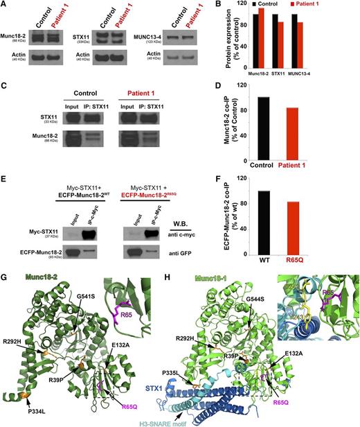 Figure 2. The STXBP2 mutation does not influence protein expression or the Munc18-2/STX11 interaction. (A) Western blots showing the expression levels of Munc18-2, STX11, and MUNC13-4 in lysates prepared using PBMCs activated with CD3/28 beads from control (black) or P1 (red). Actin staining of the same membranes was used to assess for equivalent protein loading. (B) Bands in the western blot that corresponded to Munc18-2, STX11, and MUNC13-4 were quantified by densitometry and normalized to the intensity of actin in the same lane. Densitometry results are expressed as the percentage of those obtained using control samples, which were set as 100%. (C) Coimmunoprecipitation experiments using lysates generated from control or P1 PBMCs. Endogenous STX11 was immunoprecipitated (IP) using an anti-STX11 antibody, and the amount of Munc18-2 that coimmunoprecipitated was quantified by western blot analysis. (D) Bands in the western blot that corresponded to the fraction of Munc18-2 that coimmunoprecipitated (co-IP) with STX11 were quantified by densitometry and normalized to the amount of STX11 immunoprecipitated in the same lane. Densitometry results were expressed as the percentage of those obtained in control samples, which were set as 100%. (E) Coimmunoprecipitation experiments using HeLa cells transiently transfected with Myc-STX11 and ECFP-Munc18-2WT (black) or ECFP-Munc18-2R65Q (red). STX11 was immunoprecipitated (IP) using an anti-Myc antibody and the amount of Munc18-2 that coassociated was quantified by western blot analysis using an anti-GFP antibody. (F) Densitometry analysis was performed as described in panel C. In panels A-F, results are representative of 2 independent experiments. (G) Crystal structure of Munc18-2 (Protein Data Bank entry 4CCA) with the R65 residue highlighted in magenta. Previously described HLH-associated Munc18-2 missense mutants are highlighted in orange. (H) The crystal structure of Munc18-1 (green) in complex with STX1 (Habc domain: blue, H3 domain: cyan; Protein Data Bank entry 3C98) reveals that the C-terminal half of the STX1 H3 domain inserts deeply into the Munc18-1 central cavity. The R65 residue (highlighted in magenta) is in proximity to residues D242 and Y243 (yellow) within the STX1 H3 domain but it does not make direct contact with these residues. Munc18-1 residues corresponding to described missense mutations in Munc18-2 are highlighted in orange. The insets in G and H represent a higher magnification of the structure, rotated 90° clockwise in the x-axis.