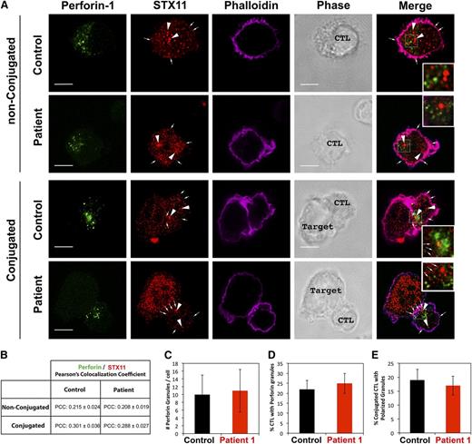 Figure 4. The R65Q mutation does not affect the subcellular localization of STX11 or the number and polarization of perforin-containing granules. (A) CTLs from a control individual or P1 were incubated in the presence or absence of anti-CD3-coated P815 cells at a 1:1 ratio for 15 minutes at 37°C on polylysine-coated coverslips. Cells were fixed, permeabilized, and stained using mouse anti-perforin-1 antibody, rabbit anti-STX11 antibody and Alexa 633-Phalloidin. Larger arrowheads show the intracellular vesicular pool of STX11. Smaller arrows show the fraction of STX11 localizing at the plasma membrane. Bars represent 5 μm. Insets display a zoomed-in view of the selected area. (B) Pearson’s colocalization coeficient (PCC) between perforin 1 and STX11 in the set of images shown in panel A. Values represent the mean ± standard deviation (SD); n = 15 cells. Quantification of the number of perforin-containing granules per cell (C) and the number of cells containing perforin granules (D) was performed using stimulated emission depletion images (as shown in panel A; nonconjugated). Data represent the mean ± SD; n = 25 cells for panel C and n = 100 cells for panel D. (E) Quantification of the number of CTLs making contact with target cells that display polarized granules. Stimulated emission depletion images (as shown in panel A; conjugated) were used to determine the percentage of CTLs in contact with target cells that exhibited polarized perforin-containing granules at the immunologic synapse among the total number of CTLs containing perforin granules. Data represent the mean ± SD; n = 50 cells.