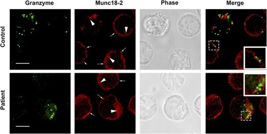 Figure 5. The R65Q mutation does not affect the subcellular localization of Munc18-2. CTLs from a control or P1 were incubated for 15 minutes at 37°C on polylysine-coated coverslips. Cells were fixed, permeabilized, and stained using mouse anti-granzyme-A or rabbit anti-Munc18-2 antibody. Large arrowheads show the intracellular pool of Munc18-2. Smaller arrows show the fraction of Munc18-2 localizing at the plasma membrane. Insets display a zoomed-in view of the selected area. Bars represent 5 μm.