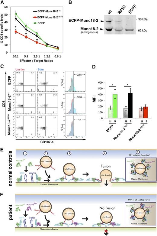 Figure 7. Expression of Munc18-2R65Q in control CTLs reduces cytolytic activity. (A) CD8+ T cells from normal control donors were transduced with lentiviral particles encoding for ECFP-Munc18-2R65Q, ECFP-Munc18-2WT, or ECFP alone. Seven days posttransduction, the cytotoxic activity against anti-CD3-coated P815 cells was tested at the indicated effector to target-cell ratios. (B) Expression levels of ECFP-Munc18-2R65Q and ECFP-Munc18-2wt were compared to endogenous Munc18-2 by western blot analysis using anti-Munc18-2 antibody. (C) CD107a degranulation assay for ECFP-expressing cells. ECFP+ cells were purified by cell sorting and were incubated in the presence (stim; blue) or absence (unstim; red) of CD3-coated P815 cells for 4 hours at 37°C. Cells were stained using anti-CD107a-PE, anti-CD56-APC, anti-CD8-FITC, and anti-CD3-PerCP antibodies and analyzed by flow cytometry. CD3+CD8+CD56– cells were gated and analyzed for the appearance of CD107a on the cell surface following incubation with target cells. Plots are representative of 2 independent experiments. (D) Graph showing the percentage of cells that increased CD107a staining after stimulation and the mean fluorescence intensity (MFI) values in the CD107a-PE channel of unstimulated (u) and stimulated (s) cells. Results are the mean ± standard deviation of 2 independent measurements. *P < .01. (E-F) Schematic representation depicting the mode of action of Munc18-2 during lytic granule secretion in a normal control (E) or patient cell carrying the STXBP2R65Q mutation (F). Step 1: soluble Munc18-2WT and Munc18-2R65Q can bind monomeric STX11 on the acceptor membrane (probably the plasma membrane). Step 2: lytic granules approach the plasma membrane on cell activation. Step 3: both Munc18-2WT and Munc18-2R65Q facilitate SNARE-complex assembly between specific v-SNAREs (such as Vamp8) and target-SNAREs (such as STX11 and SNAP23). Step 4: Munc18-2R65Q, but not Munc18-2WT, may arrest some SNARE complexes in a partially zippered state and thus uncouple their coordinated action, which is required for membrane fusion. Step 5: top view of a lytic granule docked at the plasma membrane. The dominant-negative effect of Munc18-2R65Q might result from the fact that it inactivates some of the SNARE complexes involved in the membrane fusion reaction, thereby reducing the energy generated and inhibiting lytic granule fusion with the plasma membrane.