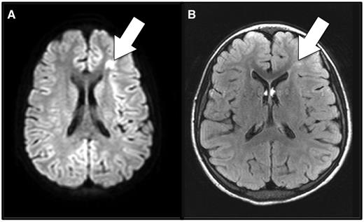 Anemia and cerebral ischemia. Shown here is magnetic resonance imaging of the brain during (A) and 7 months after (B) an acute anemic event in a patient with sickle cell anemia who had no focal neurologic signs corresponding to the brain lesion. A focus of restricted diffusion on diffusion-weighted imaging (A) indicates this is an acutely ischemic lesion. (B) Typical, T2-hyperintense, permanent silent cerebral infarct corresponding to the focus of the acute ischemia detected during the acute anemic event. The imaging was obtained for a screening clinical research study, not for clinical suspicion of stroke.