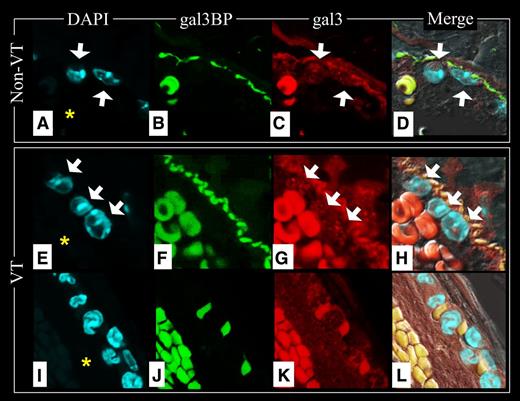 Figure 7. Gal3BP and gal3 at the lumen/IVC interface. Non-VT images: Top raw (A-D); VT images 48 hours after thrombosis was initiated from an area where there was not thrombus/vein wall contact, middle raw (E-H); and VT images 48 hours after thrombosis was initiated from an area where there was thrombus/vein wall fusion, bottom raw (I-L). Note that vein wall gal3 and gal3bp are abundant in areas where the thrombus is not contacting the vein wall (F-G), but disappear in areas where the thrombus contacts the vein wall (J-K). Red blood cell fluorescence is predominately nonspecific autofluorescence. The IVC lumen is indicated with an asterisk in DAPI images. White arrows indicate WBCs. (A,E,I) Nuclear DAPI staining. (B,F,J) Gal3bp localization (FITC). (C,G,K) Gal3 localization (Texas Red). (D,H,L) Merge of images.