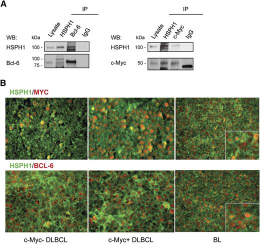 Figure 2. HSPH1 interaction with c-Myc and Bcl-6 in human aggressive B-NHLs. (A) Western blot analyses of HSPH1 and Bcl-6 (left) or HSPH1 and c-Myc (right) in Namalwa whole-protein extract immunoprecipitated (IP) with Abs against the indicated molecules or control isotype IgG. Whole lysate was included as an internal control. For c-Myc immunoprecipitation, proteins were eluted in nonreducing condition to avoid the detection of Ab heavy chains in the region in which c-Myc protein migrates. Western blot images were acquired using Microtek ArtixScan F1 and cropped to retain the relevant bands with Adobe Photoshop CS version 4 for Macintosh computer. (B) Representative microphotographs of double-marker immunofluorescence for HSPH1 (green signal) and either Bcl-6 or c-Myc (red signal) in 2 cases of germinal center–type DLBCLs with (middle) or without (left) c-Myc amplification, and 1 case of BL (right). Bindings of primary rabbit anti-human HSPH1 Ab and mouse anti-human Bcl-6 (clone PG-B6p) or anti-human c-Myc (clone 9E10) were revealed, respectively, by an Alexa-488– and an Alexa-568–conjugated secondary Abs. Sections were analyzed under a Leica DMRBE microscope and microphotographs were collected with a Leica MC120HD digital camera.