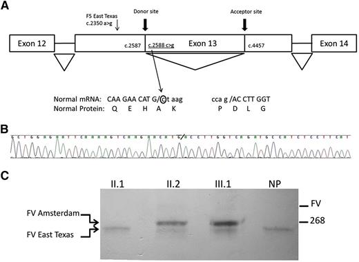 Figure 2. Diagram of the novel splicing event, sequencing results of the F5 gene, and direct interaction between FV Amsterdam and TFPI. (A) cDNA sequencing from the polymerase chain reaction product of the proband revealed a sequence that is not concordant with the reference transcript from National Center for Biotechnology Information (NM_000130.4). The F5 mutation created a novel donor site at the coding position 2588, which together with an aberrant acceptor site at position 4457 of exon 13 (same as reported for the East Texas bleeding disorder) leads to a shorter F5 transcript. The new sequence is missing 1869 nucleotides in exon 13 (c.2588_4456del) that results in an in-frame loss of 623 amino acids. Diagram of the gene is not to scale. Adapted from Vincent et al.2 (B) Sequencing results of the new transcript found in the proband. The novel donor splice site is indicated by a backslash. (C) Plasma of individuals was incubated with anti-TFPI-coated beads. Bound proteins were eluted, separated by sodium dodecyl sulfate-polyacrylamide gel electrophoresis, and immunoblotted with antibodies against FV. Variant forms of FV can be visualized as indicated. NP, normal plasma.