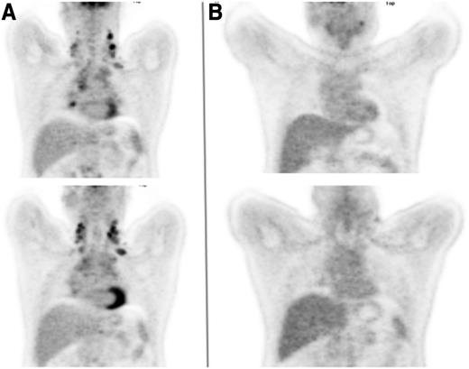Figure 1. Coronal FDG-PET images of the thorax. (A) Prior to initiation of therapy and (B) following 2 cycles of ABVD.