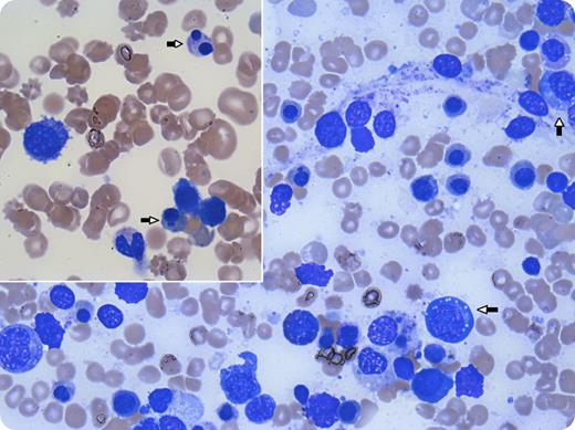 A 4-year-old girl with a known history of methylmalonic acidemia (MMA) complicated by acquired hypothyroidism, failure to thrive, and developmental delay developed pancytopenia during an admission for emesis and metabolic acidosis. She had no symptoms of a viral infection, and her cytopenias worsened over 3 weeks despite resolution of her acidosis. Her complete blood count showed a total white blood cell count of 3.1 × 109/L with an absolute neutrophil count of 510 /μL, hemoglobin of 6.8 g/dL, and platelets of 24 × 109/L. Given the long duration and unusual severity of the cytopenias, evolving aplastic anemia was considered, and a bone marrow aspirate and biopsy were performed. These showed trilineage hypoplasia and prominent dysplasia (see inset panel, arrows), including multiple vacuolated myeloid precursors (see large panel, arrows). Testing for underlying viral causes by serology and polymerase chain reaction was negative, as was testing for inherited bone marrow failure syndromes and myelodysplastic syndrome/leukemia. Her peripheral counts recovered spontaneously and fully over the ensuing 4 weeks. Interestingly, she was found to have recurrence of cytopenias on subsequent admissions for MMA-associated metabolic crises, correlating with the level of acidosis. / Patients with MMA and other organic acidemias can develop bone marrow hypoplasia and trilineage dysplasia during metabolic crises, a phenomenon that has been described in a few case reports in the older literature. Cytopenias tend to correlate with organic acid levels in the blood, and count recovery typically occurs within 2 weeks, after normalization of the metabolic state. No specific treatment is needed outside of supportive care.