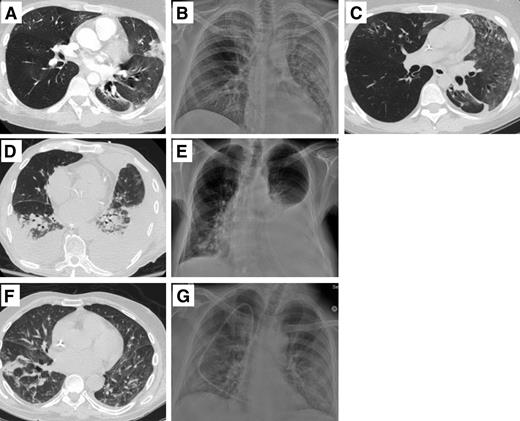 Figure 2. Selected radiographic images from patients with presumptive EV-D68 infection. (A) Case 2, day −3 CT: ground glass opacities and nodule airspace opacities throughout, and consolidation in lingula and L lower lobe. (B) Case 2, day +3 chest radiograph (CXR): diffuse L lung disease and patchy R lung disease; possible bilateral pleural effusion. (C) Case 2, day +18 CT: worsening ground-glass L upper lobe, and patchy ground-glass R right upper and middle lobes. (D) Case 3, day −1 CT: patchy consolidation R lower lobe, and nodules in both lower lobes; mild interlobular septal thickening. (E) Case 3, day +4 CXR: bilateral basilar consolidation. (F) Case 7, day +1 CXR: increased left pleural effusion with underlying atelectasis; increased right lower lobe consolidation. (G) Case 7, day +4 CT: interval increase R pleural effusion; large L pleural effusion. New patchy consolidation R middle lobe; bilateral lower lobe consolidation.