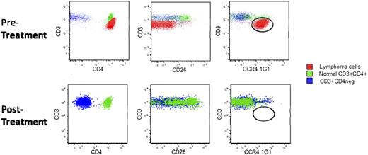 Figure 2. Response in blood to mogamulizumab in Sézary syndrome. Patient had received 6 prior systemic therapies. Total CD3+ lymphocytes from peripheral blood are shown. Red, circulating cutaneous T-cell lymphoma cells; green, normal CD3+CD4+ cells; blue, normal CD3+CD4− cells.