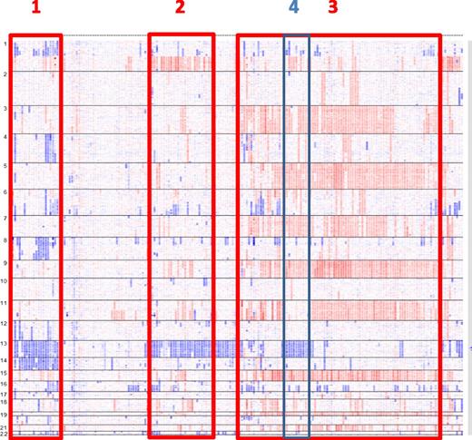 Figure 4. MM subentities defined by SNP array. In this picture of 192 patients with MM at diagnosis, several subgroups can be identified: monosomies 13 and 14 and frequent 1p deletions (1); monosomies 13 and 1q gains (2); hyperdiploidy (3); and within hyperdiploidy, patients with monosomies 13 and lack of trisomy 11 (4). Adapted from Avet-Loiseau et al30 with permission.