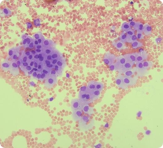 A 74-year-old man with stage IV diffuse large B-cell lymphoma underwent a lumbar puncture for staging and prophylactic intrathecal methotrexate. No neurological symptoms were reported. The cerebrospinal fluid (CSF) sample was macroscopically clear and colorless. Cytology showed numerous erythrocytes, small lymphocytes, and neutrophils consistent with blood contamination. No abnormal lymphocytes were seen and flow cytometry showed no lymphoma. Additionally, many clusters of large cells were seen with plentiful cytoplasm, round to oval nucleus, and open chromatin. They were identified as normal ependymal cells. Although morphology may suggest a malignant origin, we wish to highlight the importance of recognizing these as normal CSF cells by hematopathologists/cytologists. / Ependymal cells are CSF-producing cells from the cerebrospinal surface epithelium and have a distinct morphologic appearance which differs from lymphoma or carcinoma cells. They are seen in normal CSF samples as part of traumatic artifact from the lumbar puncture needle as well as the CSF of patients with central nervous system infections and/or subarachnoid hemorrhage and in hydrocephalic children. Correctly identifying ependymal cells in this case correlated with other features of a traumatic tap in an otherwise normal CSF. This case highlights the need for understanding all normal cellular components in a CSF cytological examination to recognize artifact and distinguish from malignancy.
