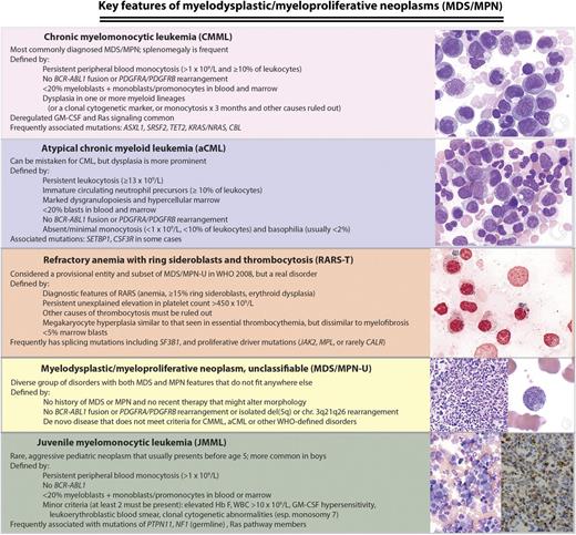 WHO (2008) classification of MDS/MPNs: disease definitions and key molecular features. Chronic myelomonocytic leukemia (CMML), atypical chronic myeloid leukemia (aCML), MDS/MPN-U, and left juvenile myelomonocytic leukemia (JMML) micrographs are Wright-Giemsa stained marrow aspirate. Right JMML micrograph is a CD68 immunostain highlighting neoplastic marrow monocytes, and refractory anemia with ring sideroblasts and thrombocytosis (RARS-T) image is a Prussian blue reaction demonstrating numerous ring sideroblasts. Microscopy conditions are described at http:imagebank.hematology.org. GM-CSF, granulocyte-macrophage colony stimulating factor; Hb F, fetal hemoglobin; MPN-U, unclassifiable MDS/MPN; WBC, white blood count; WHO, World Health Organization. Image source: ASH Image Bank (© American Society of Hematology); images (top to bottom) 2149, 2224, 2627, 4031, 2119, 1095, and 1098.